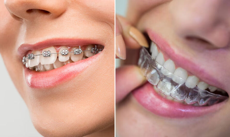 Traditional vs Invisible Braces: Making the Right Choice for Your Orthodontic Journey