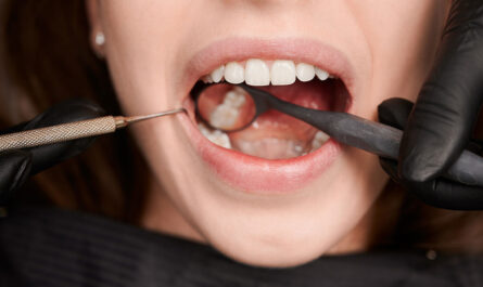 Aesthetic Fillings