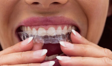 Aligner Therapy