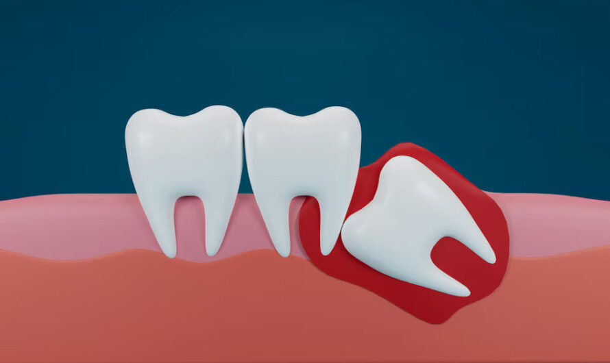 Wisdom Teeth Removal: Comprehensive Guide