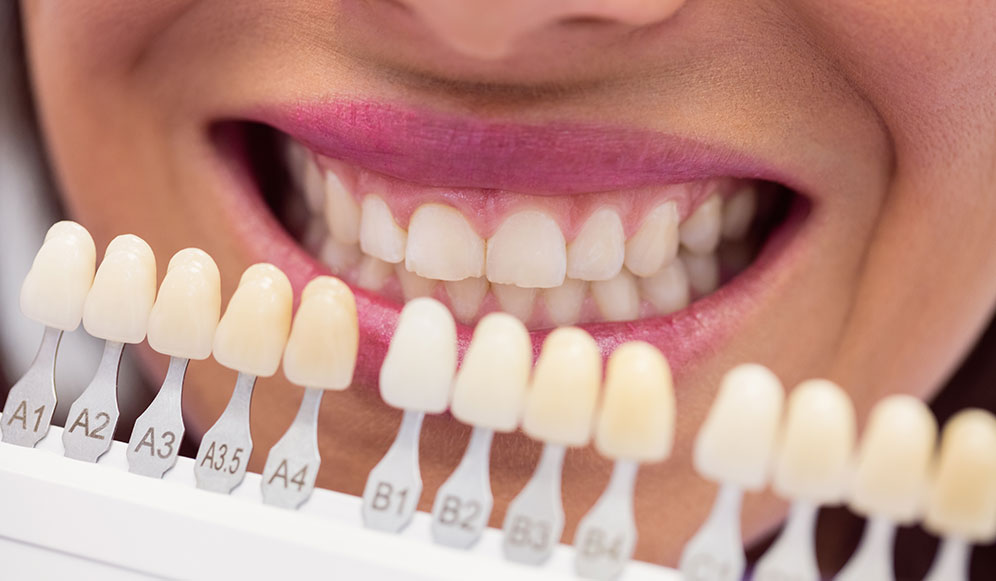 Teeth Whitening