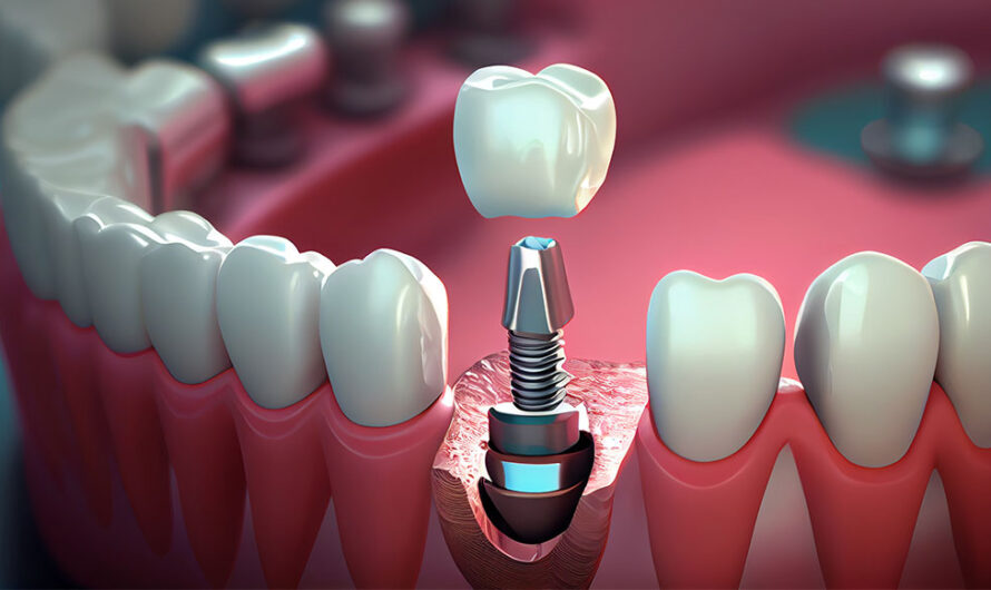 How Much Do Dental Implants Really Cost Beyond the Basics?