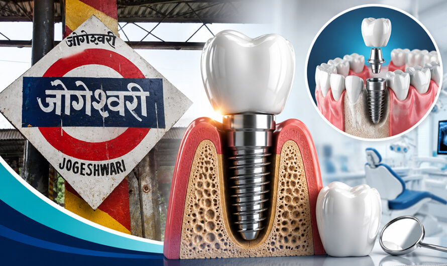 Dental Implants in Jogeshwari, Mumbai: Cost, Procedure, Benefits & Everything You Need to Know