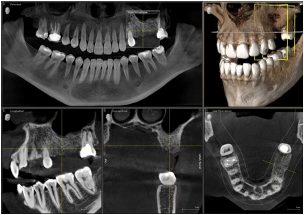 Advanced Digital Implant Dentistry