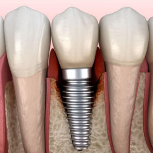 Cheap vs. Premium Dental Implants: Is the Extra Cost Worth It? 3 Cheap Implants