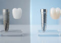 Cheap vs. Premium Dental Implants