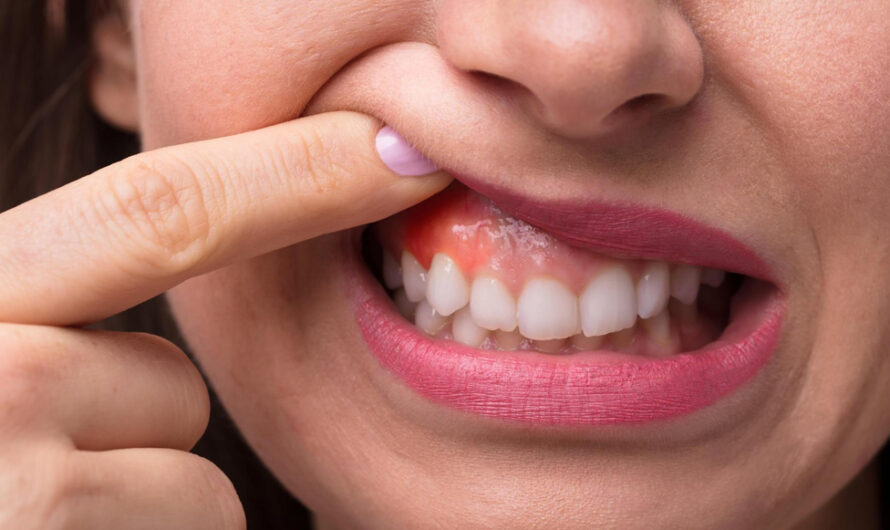 Dental Abscess vs. Swollen Gums: How to Spot a Dangerous Mouth Infection