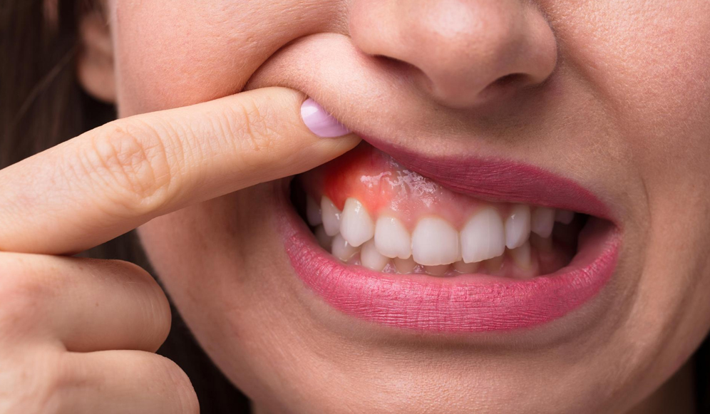 Dental Abscess vs. Swollen Gums