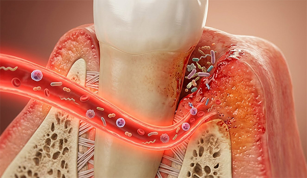 The Deep Connection Between Diabetes and Gum Disease: Why Blood Sugar Control Impacts Your Smile 3 How Gum Infections Worsen Diabetes