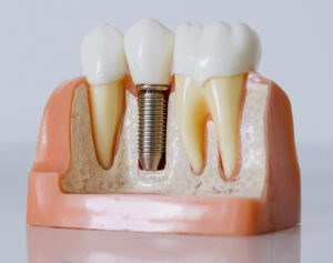 Cheap vs. Premium Dental Implants: Is the Extra Cost Worth It? 2 Premium Dental Implant