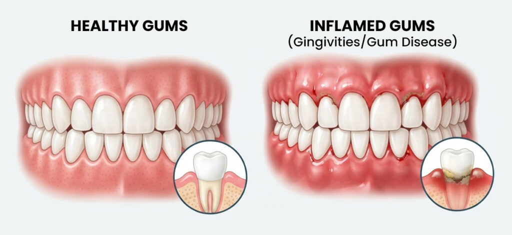 Dental Abscess vs. Swollen Gums: How to Spot a Dangerous Mouth Infection 2 Swollen Gums Identification