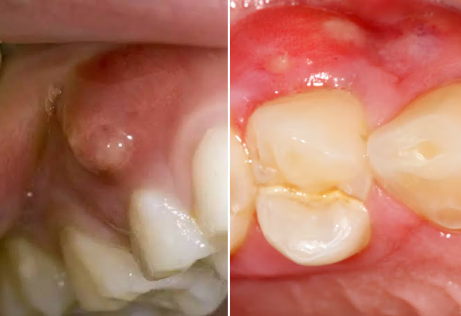Dental Abscess vs. Swollen Gums: How to Spot a Dangerous Mouth Infection 3 What is a Dental Abscess