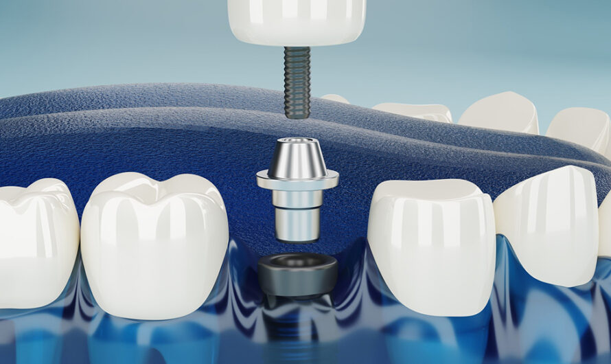 Same-Day Dental Implants vs. Traditional Implants: Which Option is Right for You?
