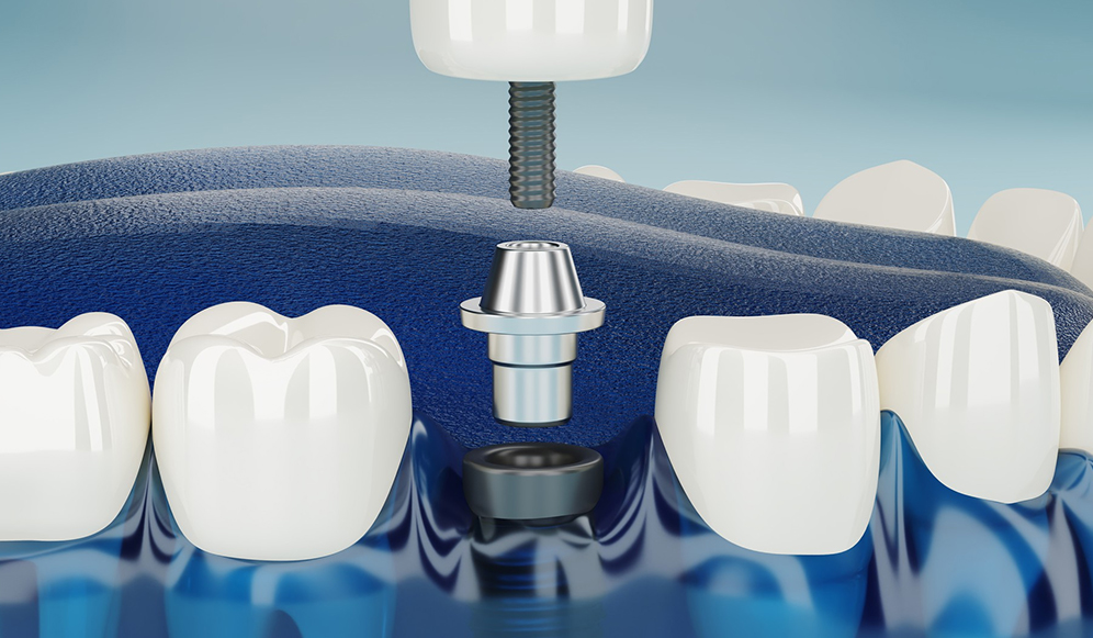 dental implants same day