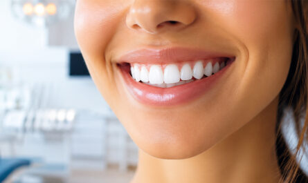 A Comprehensive Cost and Longevity Breakdown for a Hollywood Smile