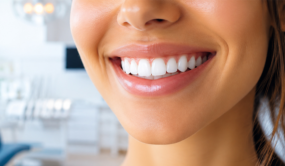 A Comprehensive Cost and Longevity Breakdown for a Hollywood Smile