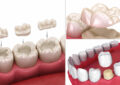 E.max Onlays, Inlays, and Table Tops vs. Traditional Caps After a Root Canal