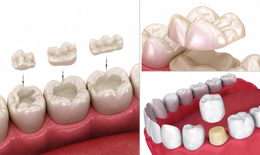 Beyond Crowns: Conservative E.max Onlays, Inlays, and Table Tops vs. Traditional Caps After a Root Canal