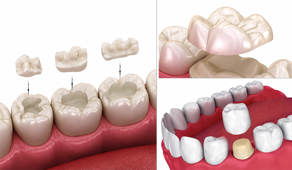 E.max Onlays, Inlays, and Table Tops vs. Traditional Caps After a Root Canal