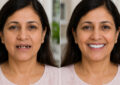 Beyond Single Teeth How Implant Supported Smile Designing Restores Both Function and Youthful Aesthetics