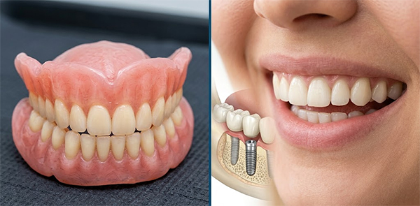 Traditional Dentures vs Implant Supported Smile Designing