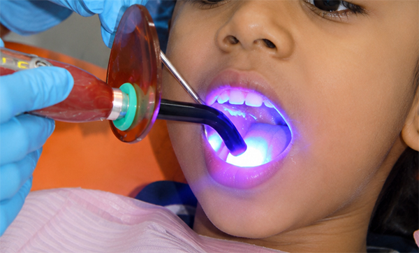 Pediatric Dental Sealants: The 20-Minute Painless Shield to Protect Your Child’s Teeth From Cavities Permanently 3 pediatric dental procedure