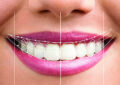 3D Digital Smile Design (DSD)