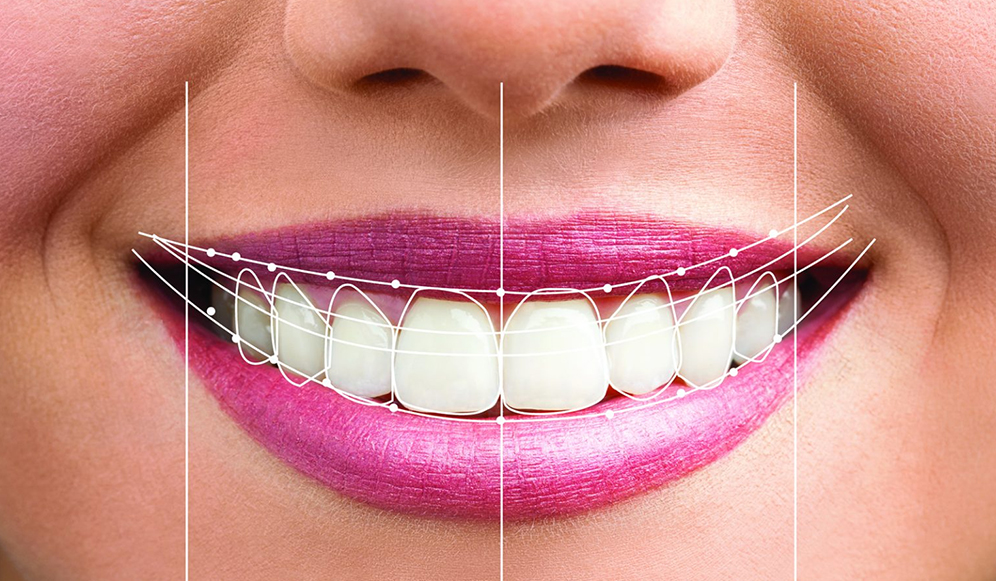 3D Digital Smile Design (DSD)