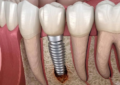 Dental Implant Failure Signs: How to Spot the Early Warning Signals