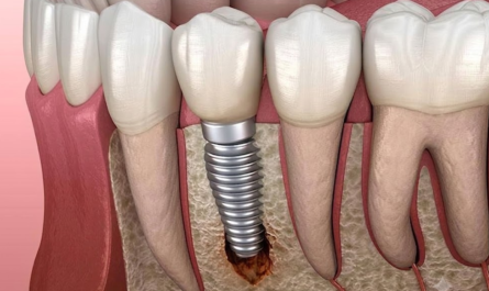 Dental Implant Failure Signs: How to Spot the Early Warning Signals