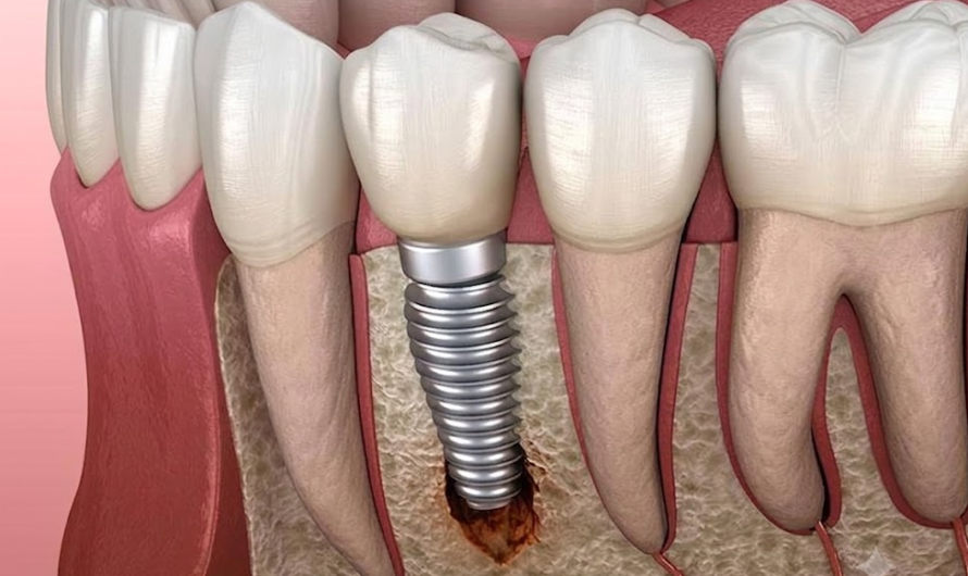 Dental Implant Failure Signs: How to Spot the Early Warning Signals