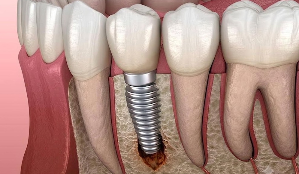 Dental Implant Failure Signs: How to Spot the Early Warning Signals
