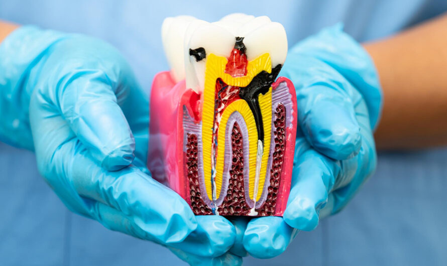 Root Canal Rehabilitation: Saving Natural Teeth with Precision