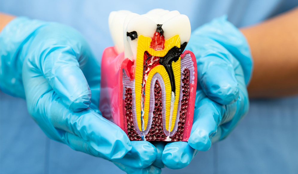 Root Canal Rehabilitation