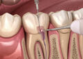 Single-Sitting RCT vs. Traditional Multi-Visit Root Canals