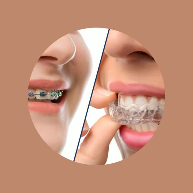 Braces / Invisalign