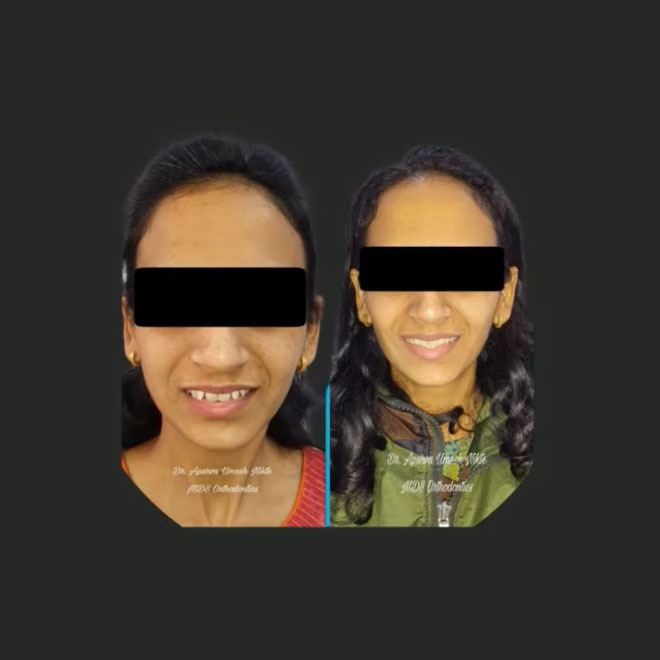 Braces / Invisalign