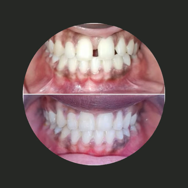 Braces / Invisalign