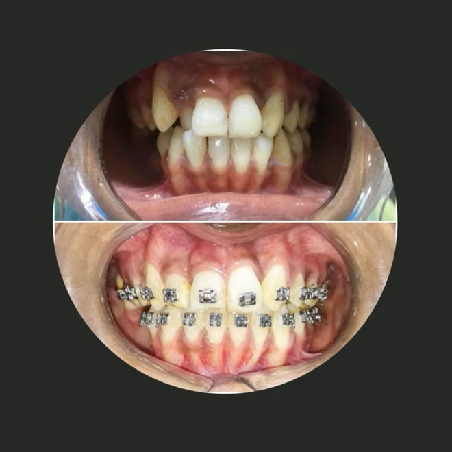 Braces / Invisalign
