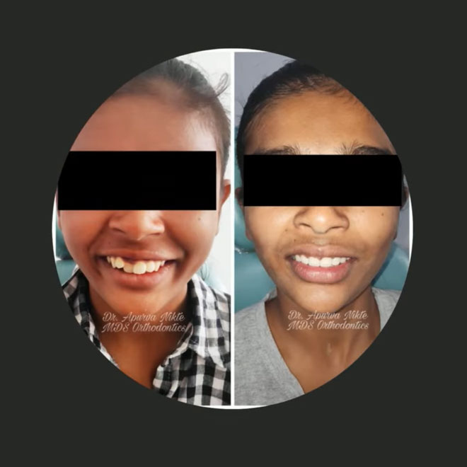Braces / Invisalign