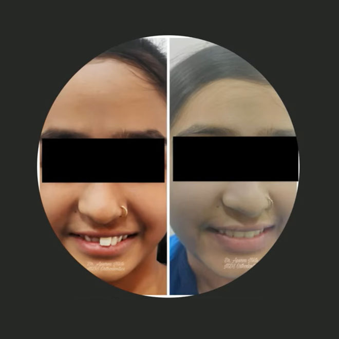 Braces / Invisalign