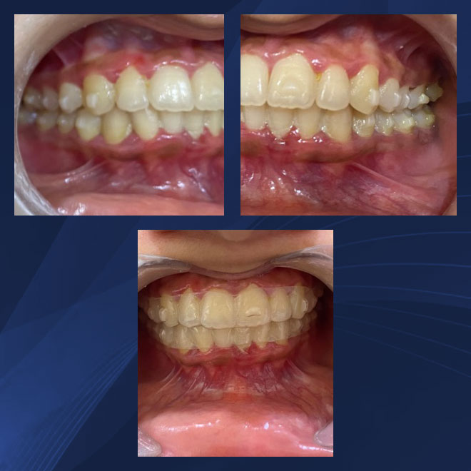 Braces / Invisalign