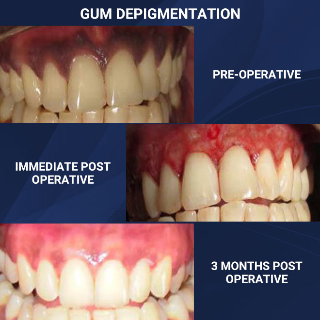 Cleaning & Gum Procedures