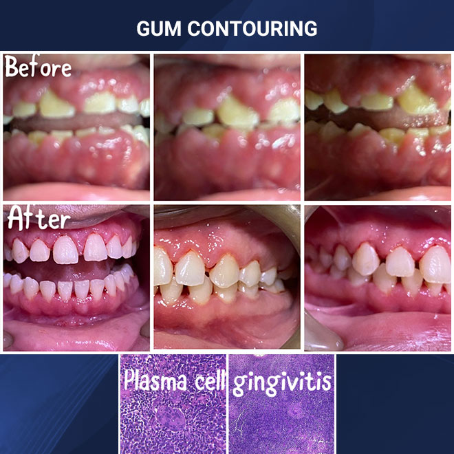Cleaning & Gum Procedures