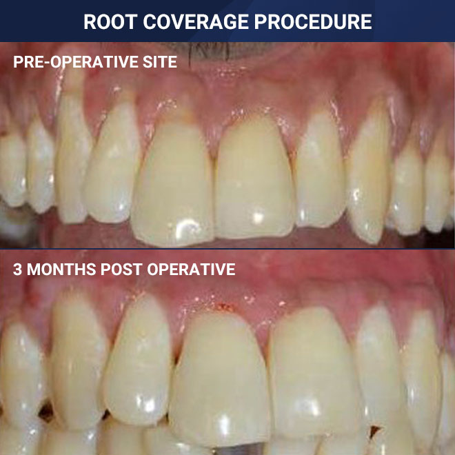 Cleaning & Gum Procedures