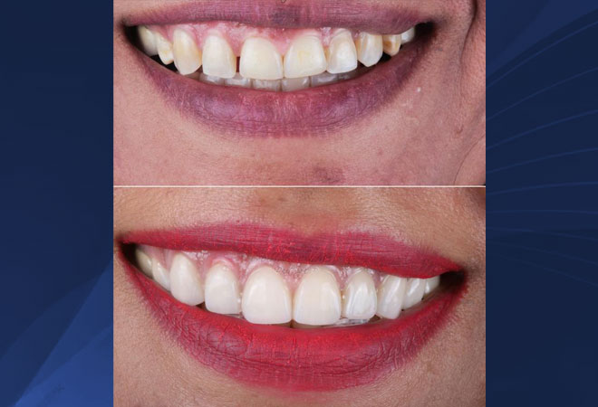 Laminates & Veneers