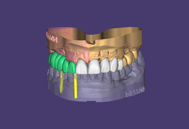 Laminates & Veneers
