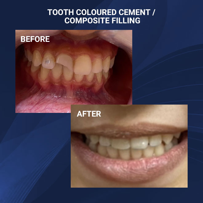 Fillings & Restorative dentistry