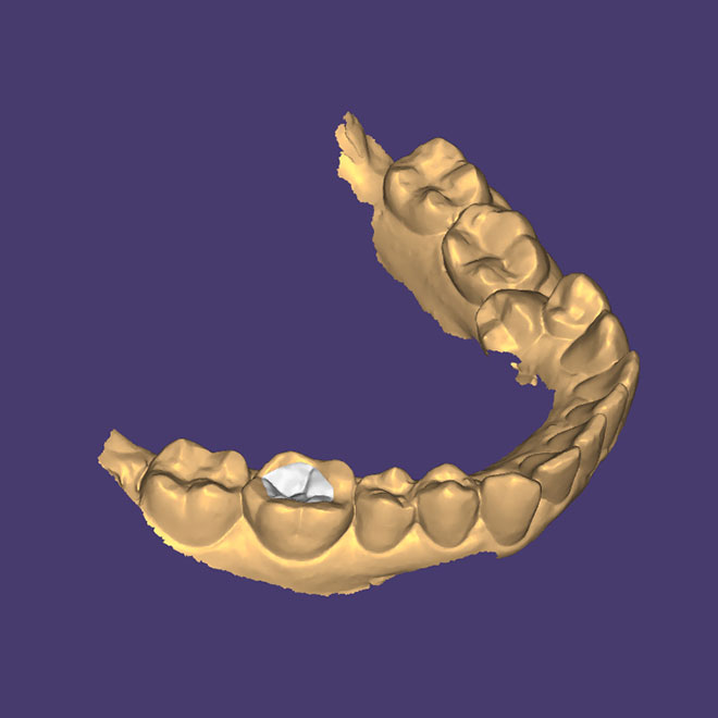 Fillings & Restorative dentistry