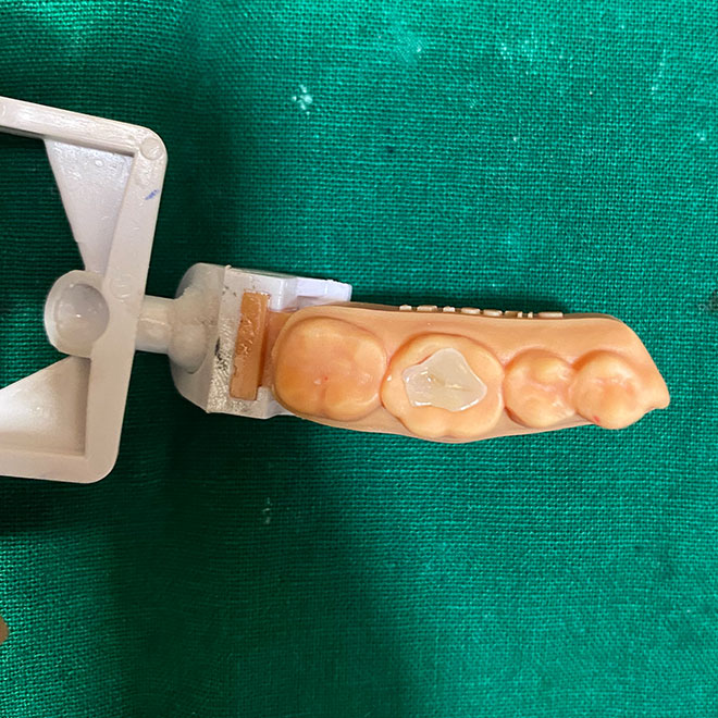 Fillings & Restorative dentistry